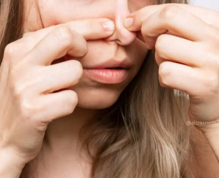 Does Oily Skin Cause Blackheads