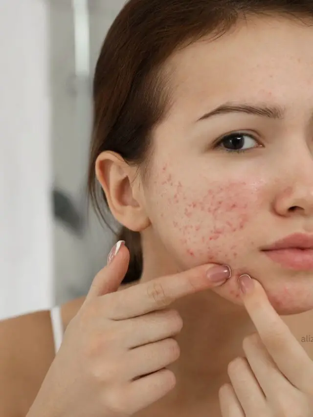 Acne Prone Skin care