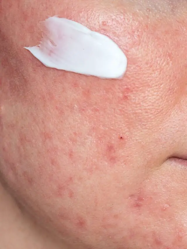 Sulfur For Acne Before And After