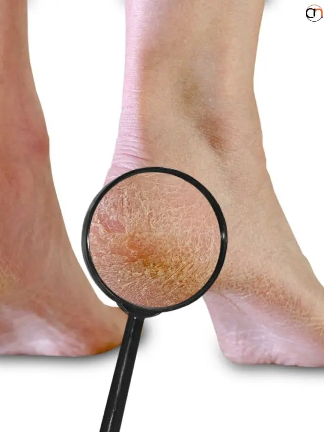 cropped-home-remedies-for-badly-cracked-feet.jpg