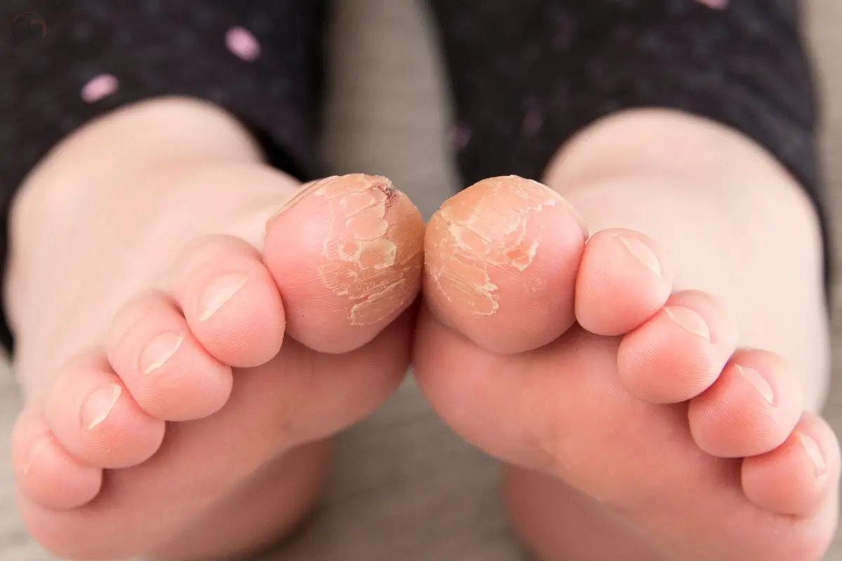 Cracked Toes Home Remedies