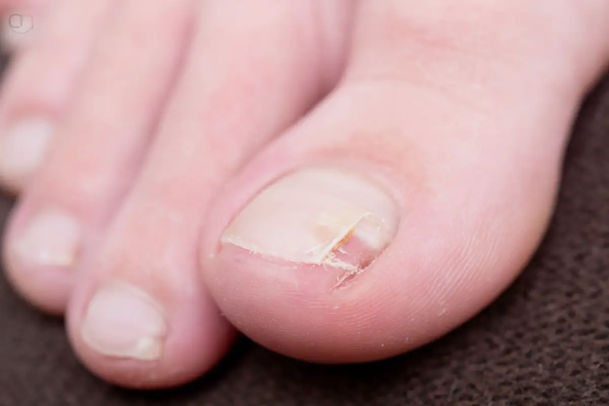 why do my toenails look weird after removing nail polish