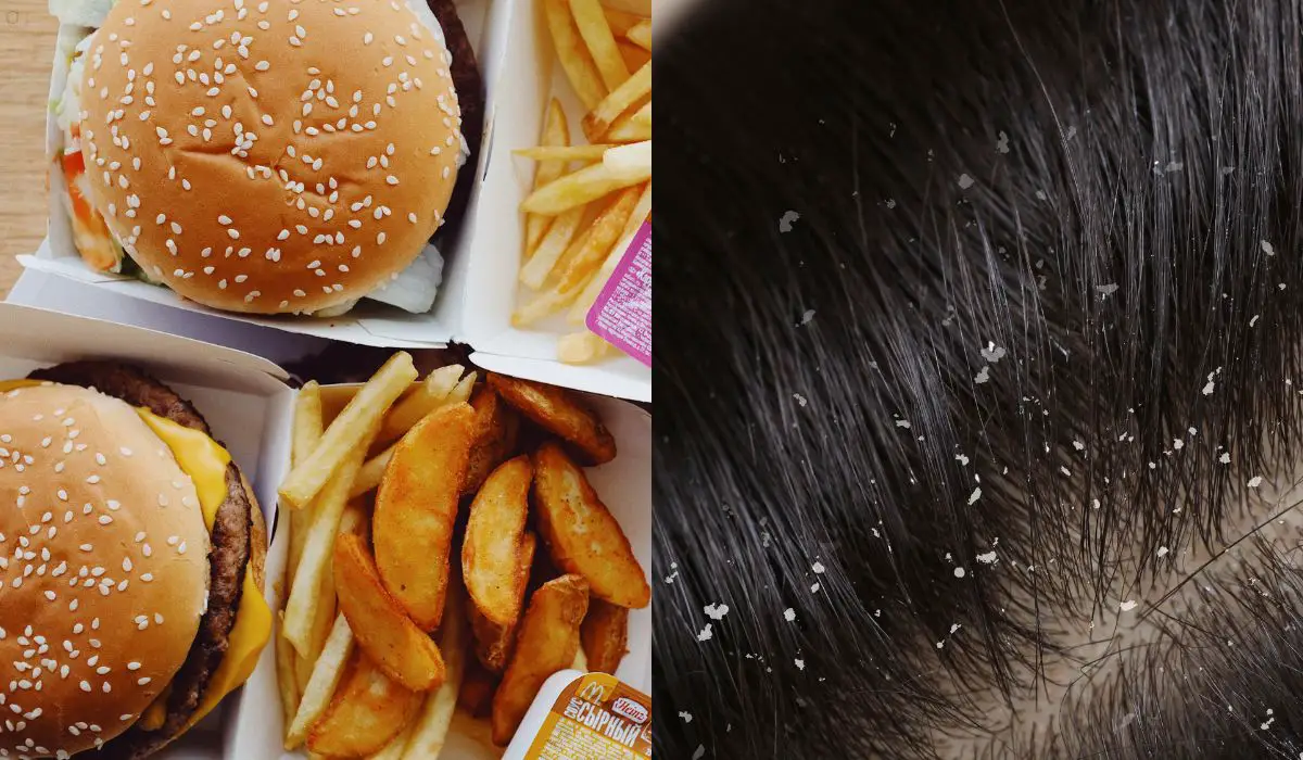 Foods To Avoid Dandruff