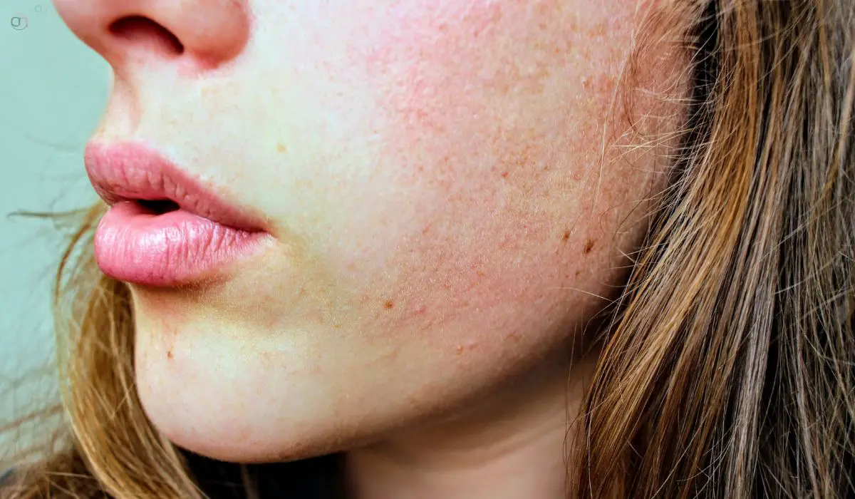 How To Cure Dry Skin On Face Overnight Home Remedies