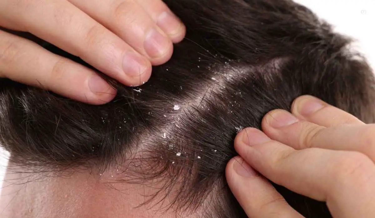 How To Remove Dandruff At Home In One Wash