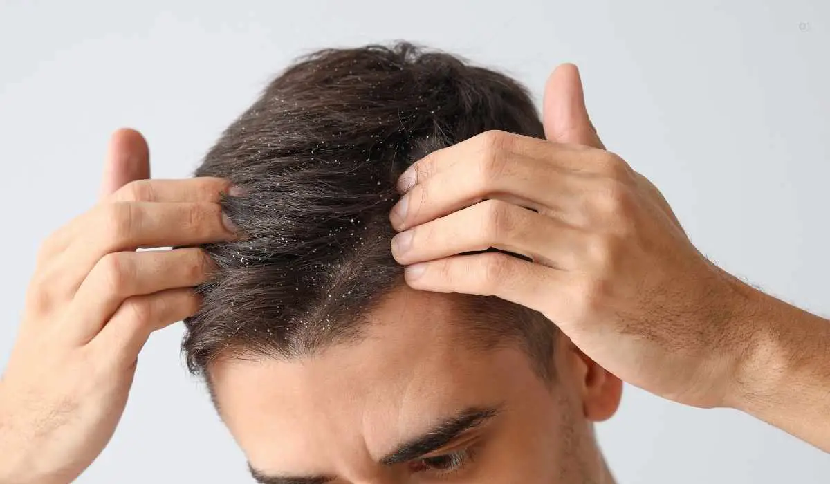 How To Remove Dandruff In One Day
