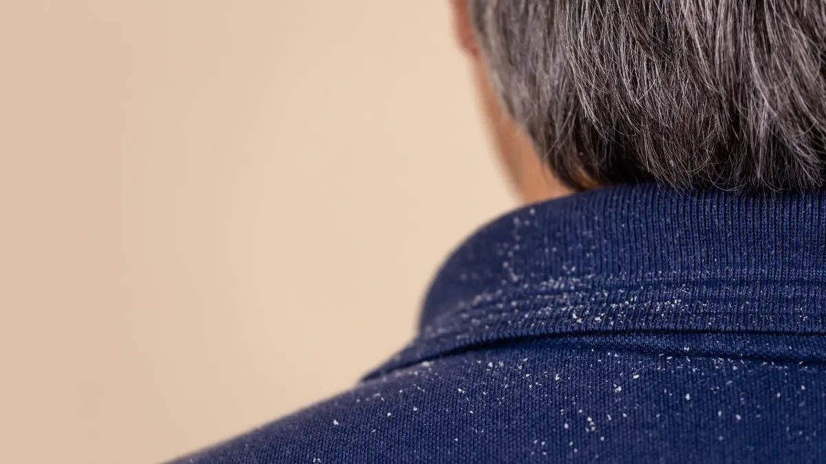 How To Get Rid Of Dandruff