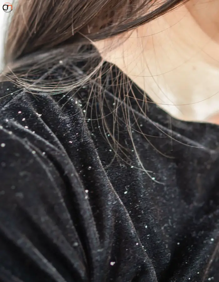 What is dandruff
